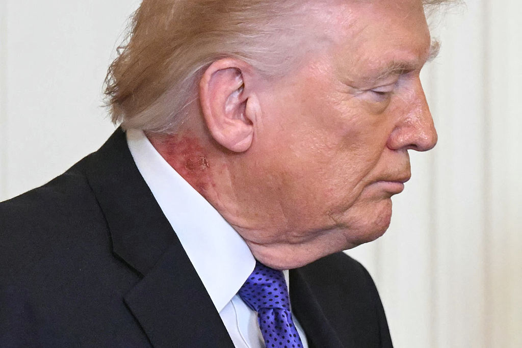 Can’t Blame Handshaking For This: Donald Trump’s Neck Rash Internet Chatter